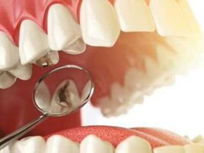عصب کشی دندان چه عوارضی دارد؟