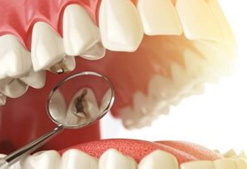 عصب کشی دندان چه عوارضی دارد؟